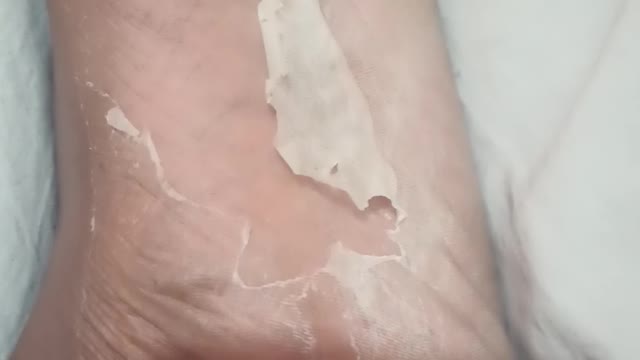 Skin Peeling