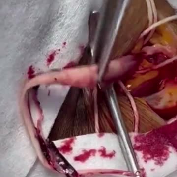 Removing Clots From those who died due to the Covid vaccine!