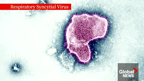 Flu vs RSV How to tell the difference between viral respiratory infections
