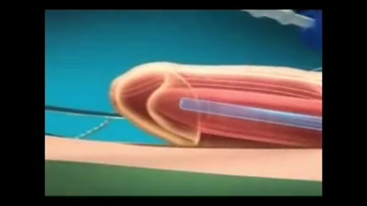 Penile implant surgery