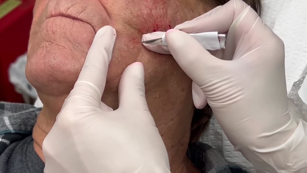 Blackhead, Blackheads, & Blackheads (Extended Leprechaun Blackheads)