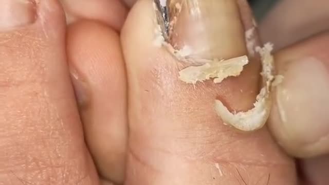 Big ingrown toenail #shorts