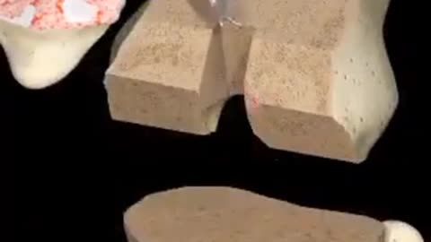 Knee replacement