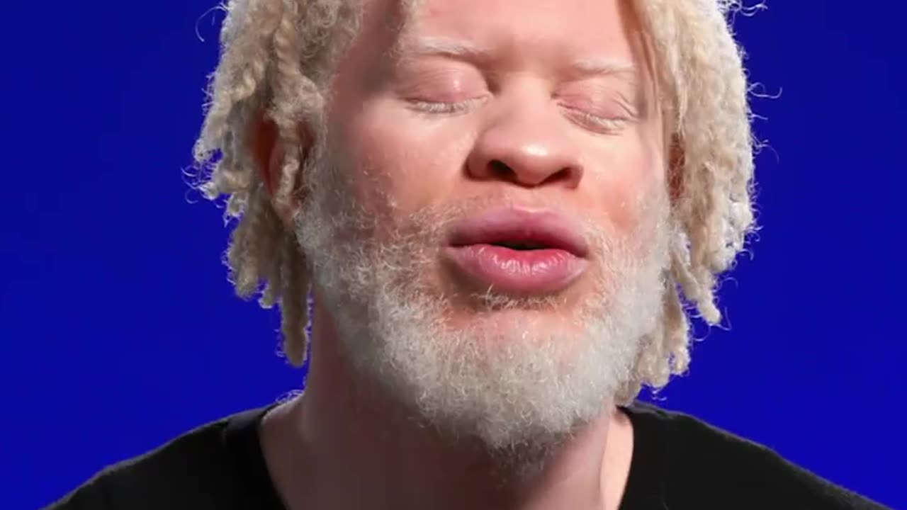 Albino model had to learn to overcome prejudices to find self-acceptance 🧡