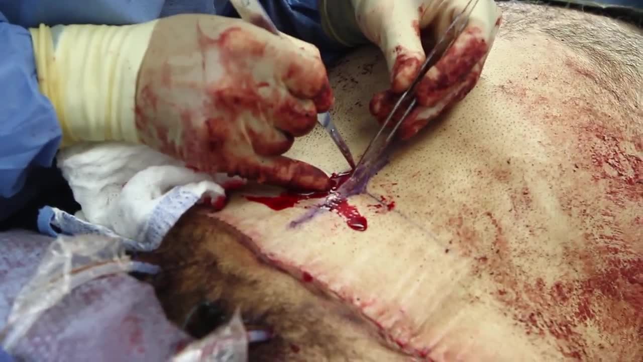 Male Tummy Tuck
