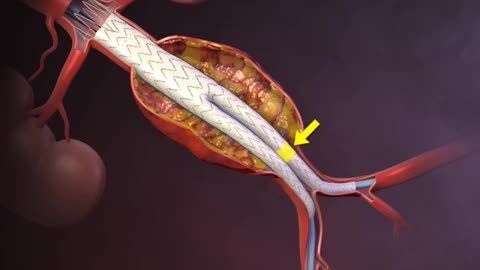 Deployment of an Endovascular Graft in an Abdominal Aortic Aneurysm