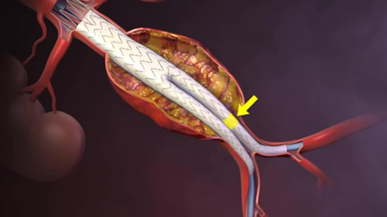 Deployment of an Endovascular Graft in an Abdominal Aortic Aneurysm