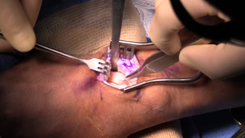 Scapholunate ligament repair