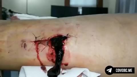 THIS IS SHOCKING 😳 A FULLY VAXXED MAN AFTER SURGERY HIS WOUND OPENS UP AND STARTED OOZING HUGE CLOTS