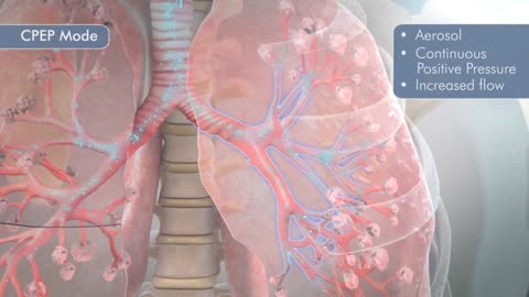 METANEB system | Prevent and Treat Pulmonary Atelectasis