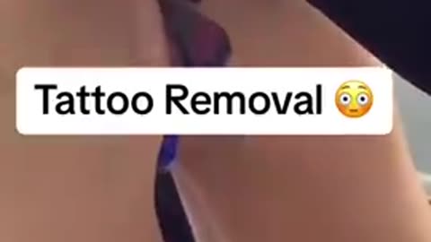 FROM THE HOLY CRAP DEPARTMENT - LASER BUTT CRACK TATTOO REMOVAL - OUCH!😳 (MY THOUGHTS IN THE DESC.)