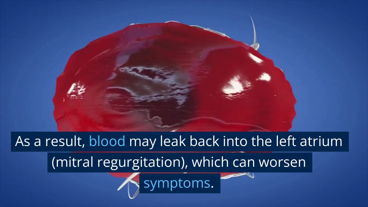 hypertrophic cardiomyopathy