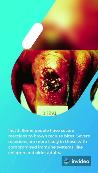 BROWN RECLUSE AMAZING FACTS ABOUT BITES # SHORTS