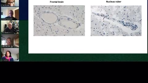 Spike protein causing blood clots in capillaries. Never has happened before now.