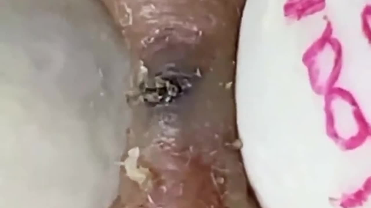 Blackheads removal 😍, Amazing Video