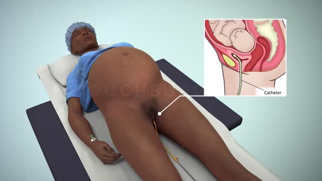 Touch Surgery Simulation - Cesarean Section (Patient information video)