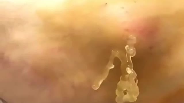 HIDROGEL VAZA EM UMA PESSOA VACINADA