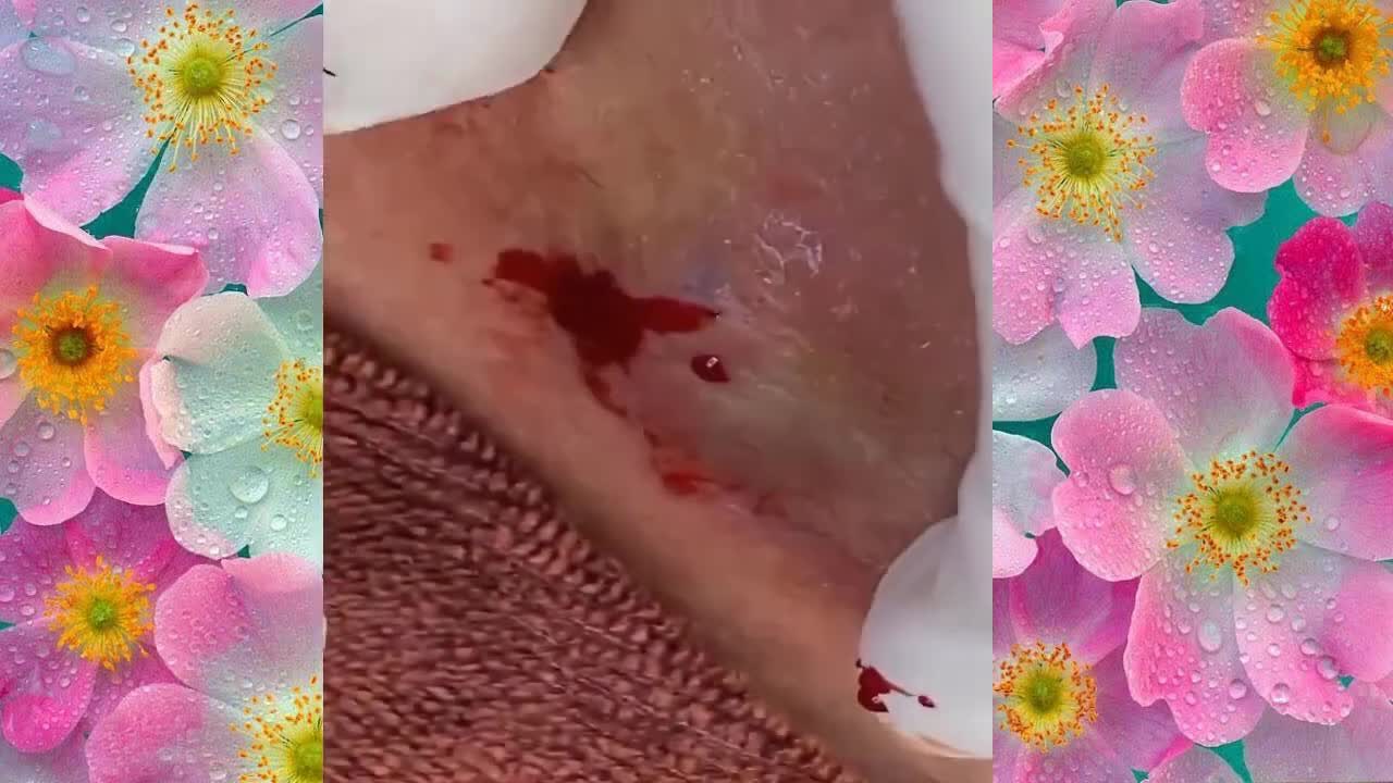 Satisfying cystic and milia pImPLe PoPpING video | 4k (blood warning)