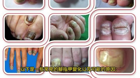 腳指甲8種變化 反映身體狀況！