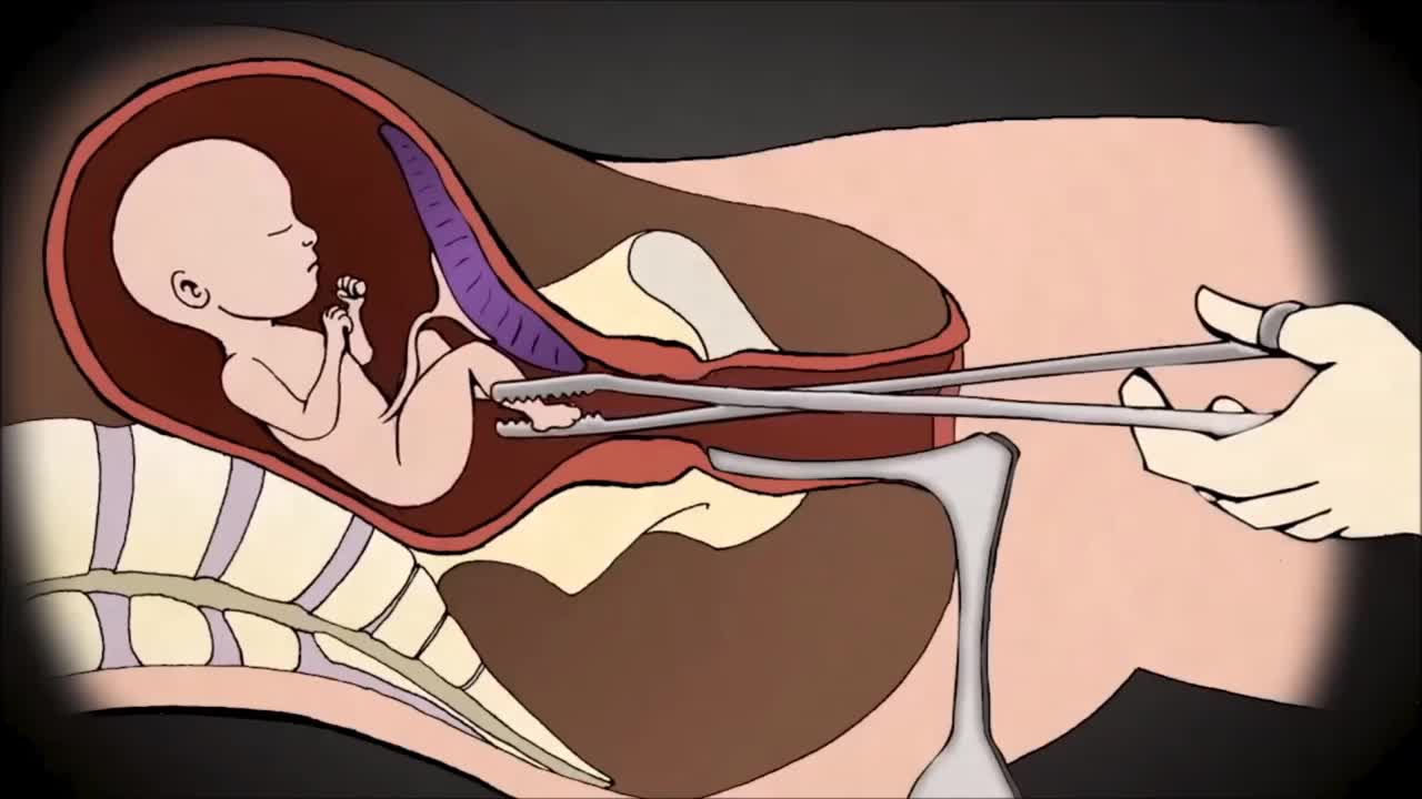 How EXACTLY Abortions are done GRAPHIC