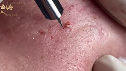 #133 | Acne Treatment Huong beauty