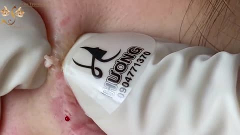 #191 Acne Treatment Huong beauty