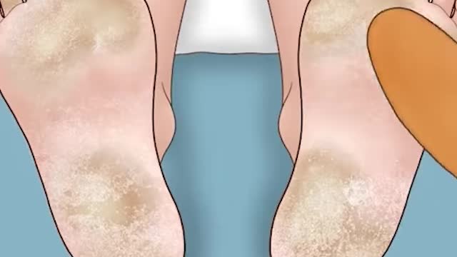 ingrown Toenail, Toenail Fungus Treatment And Callus Removal (Animation)