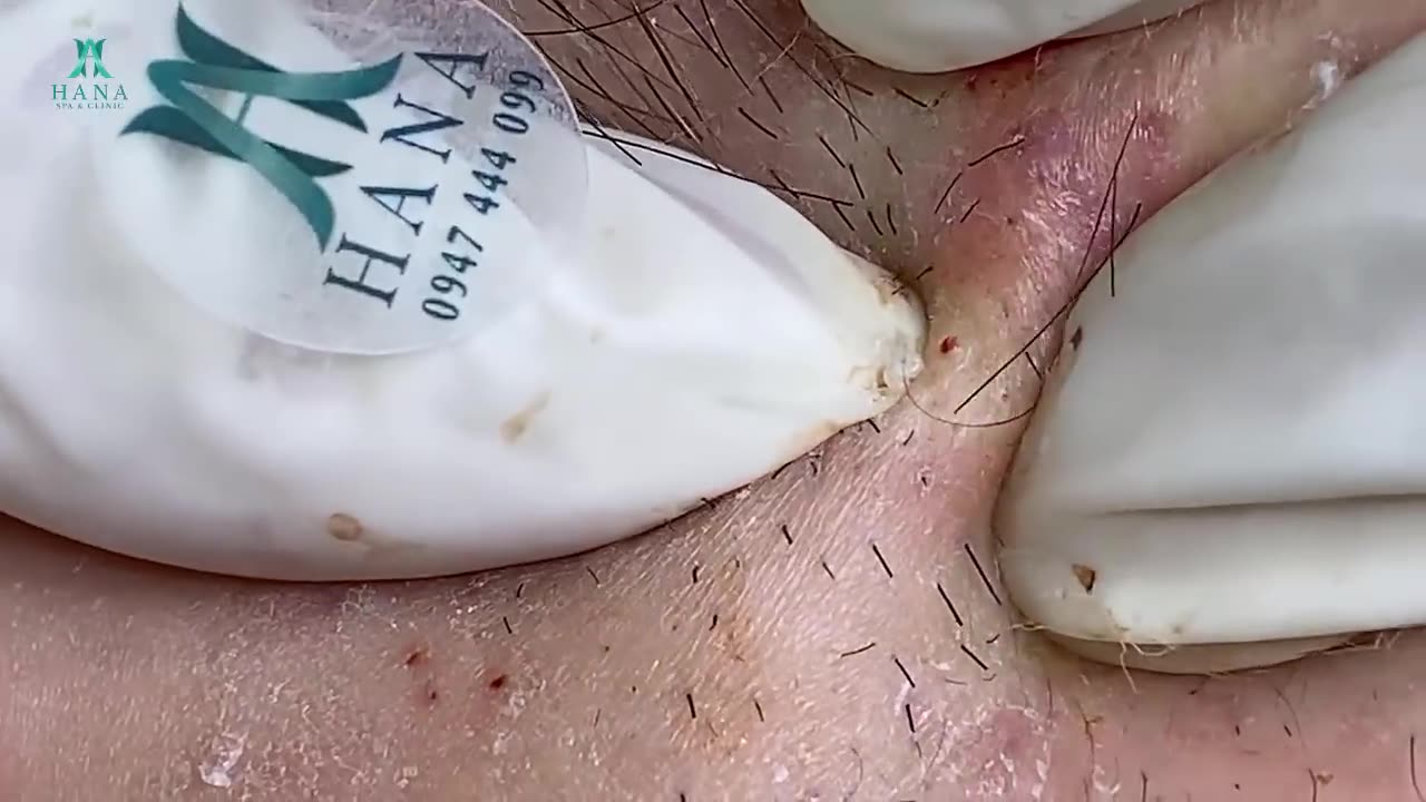 Big Cystic Acne Blackheads Extraction Blackheads & Milia, Whiteheads Removal Pimple Popping