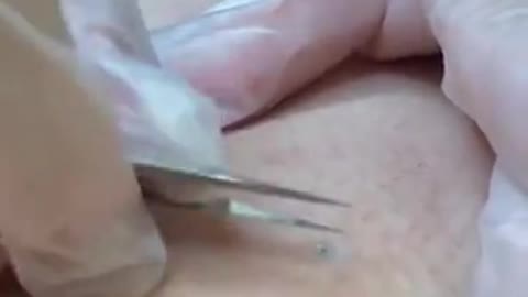 ingrown hair removal