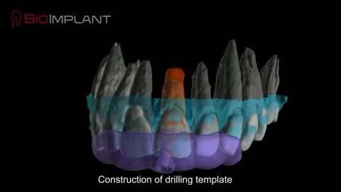 CAD/CAM PLANNING OF A TWO-PIECE ROOT ANALOGUE DENTAL IMPLANT WITH ROOT EXTENSION