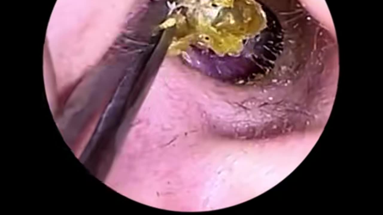 Earwax removal