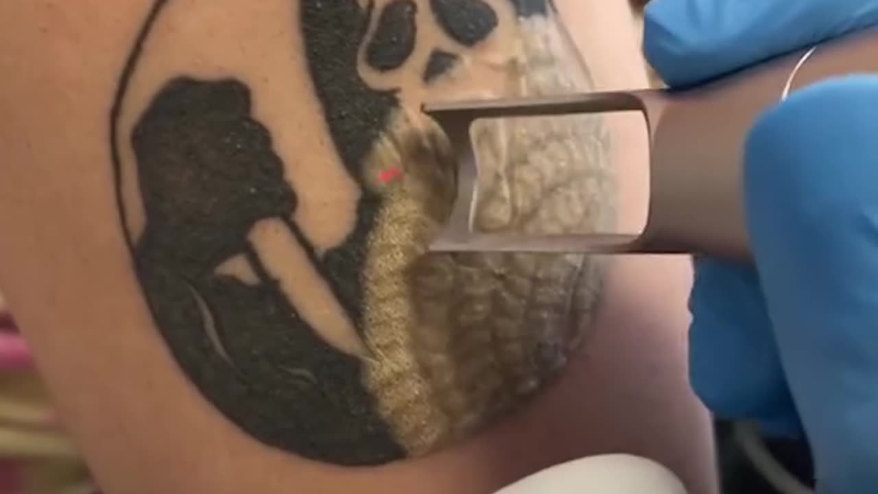 Laser removing a Scream tattoo