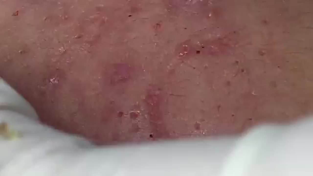 Juicy Blackheads Removal