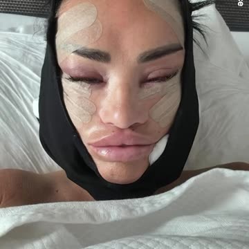 Katie Price reveals her face lift journey on Instagram