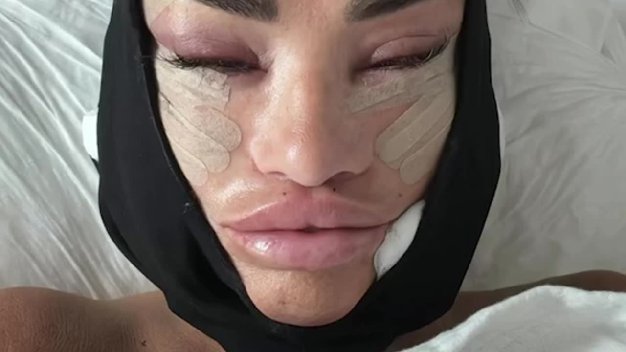 Katie Price reveals her face lift journey on Instagram