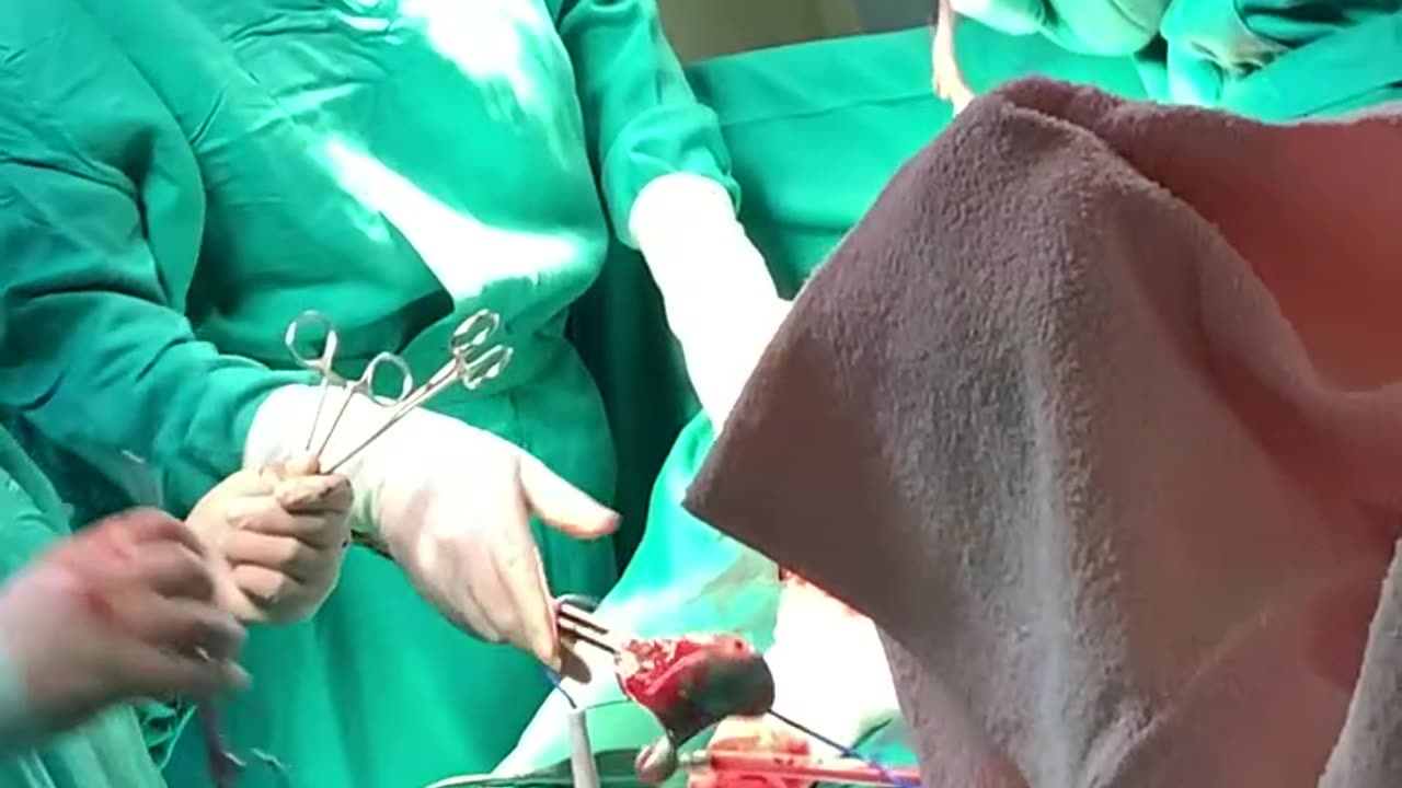 C Section full video