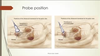 EFAST Pelvis