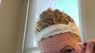 Removal of cherry angiomas with Lamprobe