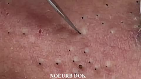 Popping Tons Of Blackheads Part 01