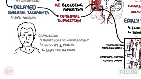 Subarachnoid Haemorrhage _ pathophysiology, complications and management