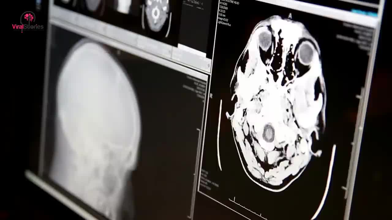Boy Born Without A Brain, 6 Years Later Look At What Doctors Find Inside