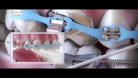 How braces works and its role