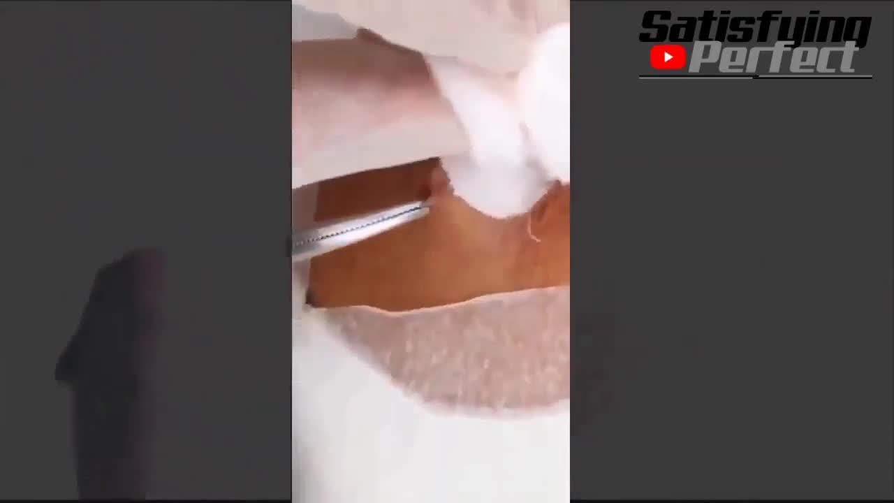 BIG CYST POPPING Crazy EXPLOSION! Watch Till The End