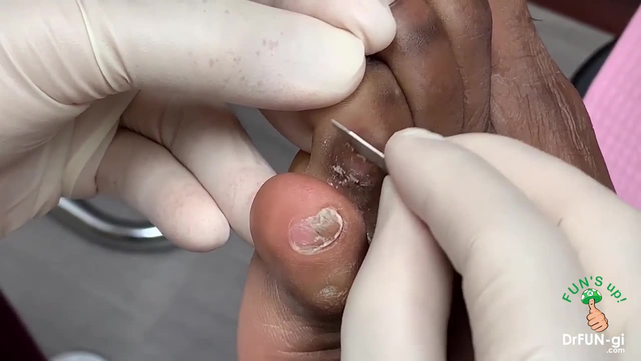 How Painful Soft Corn On Foot is Removed