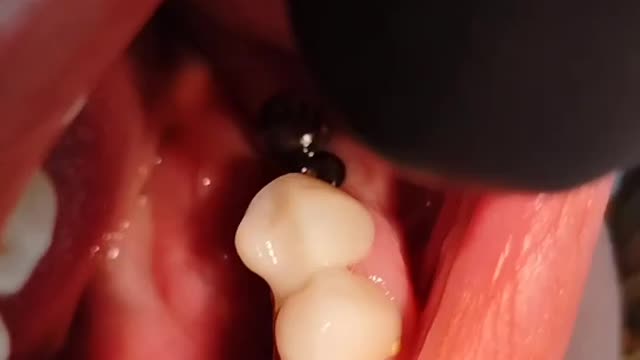 Dental implant for lower posterior