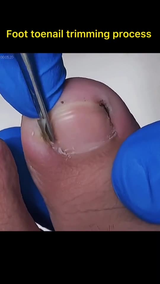 Foot toenail trimming process