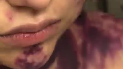 ALEXIS LORENZE 23 AÑOS OBLIGADA A VACUNARSE 3 VECES CON GRAFENO ESTAS SON LAS CONSECUENCIAS