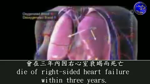 注射新冠疫苗, 在四到七天之間, 進行 D-二聚體的血液測試. 62%的病患有明確的血栓現象!! https://t.co/gTQCzfXVb5