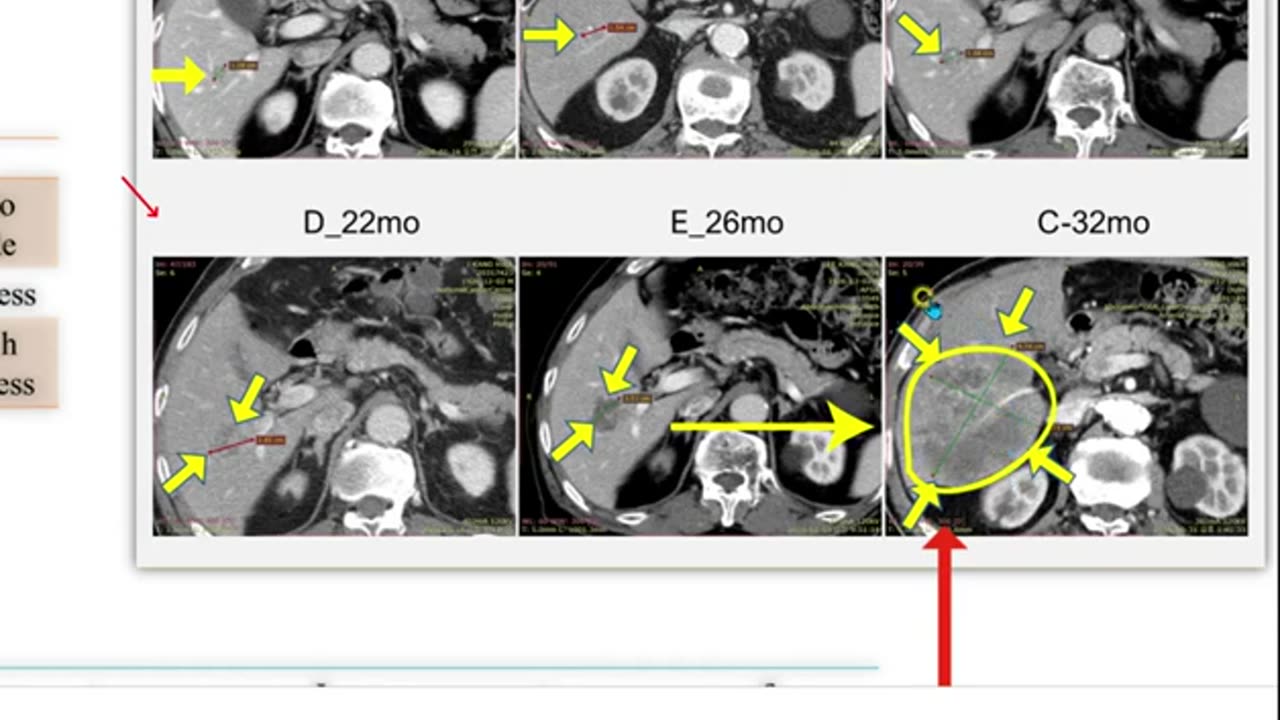 대장암 간폐전이 완치 태음인 1-2, 반룡인수한의원, 강남구청역, 한태영원장님, 사상의학