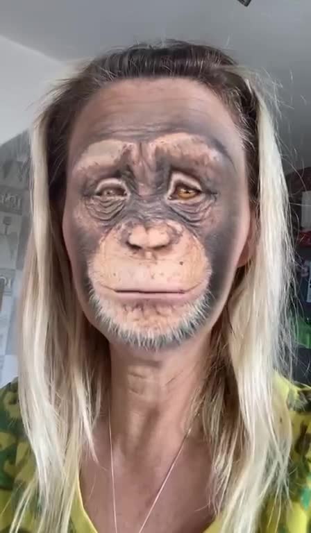 Lady with MonkiePox speaks